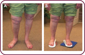 Figure 1: Alignment problems associated with different leg lengths. A) Significantly longer right leg as a result of bilateral hip and knee replacements. B) Improvement in alignment with leg length and pronation correction.