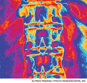 Colored X-ray of the thoracic and lumbar spine in a patient suffering from ankylosing spondylitis.