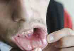 Figure 1: Virtually all patients with BS have recurrent oral ulcers, such as this one.