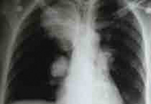 Figure 3: Pulmonary artery aneurysm in a patient with BS.