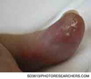 Figure 3: Tophaceous deposits on the thumb of a patient with cardiomyopathy, renal failure, and hyperuricemia who has recurrent attacks of polyarticular gout.
