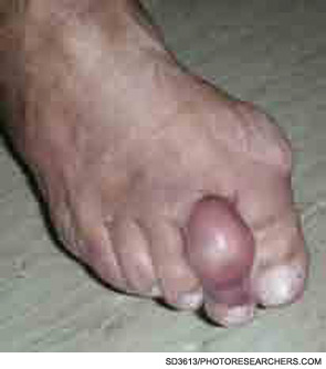 Figure 4: Acute gout of the second toe in a patient who has had gouty flares for five years despite allopurinol treatment.