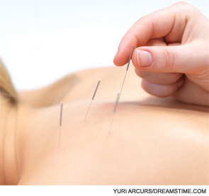 FIGURE 2: Acupuncture needles inserted into the skin.