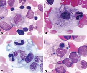 Figure 1: Activated macrophages phagocytosing hematopoietic elements in the bone marrow of a systemic JIA patient with MAS.