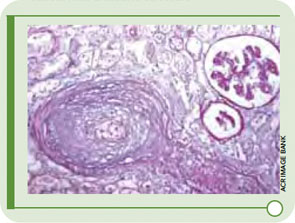 Figure 1: Fibrinoid necrosis in an arteriole supplying a glomerulus in a kidney from a patient with systemic sclerosis.