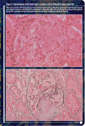 Figure 1: Renal biopsy (H&E staining) in a patient with proliferative lupus nephritis. Fibrinoid necrosis with karyorrhexis in this patient with focal proliferative glomerulonephritis (top figure) and cellular crescents with layers of proliferative endothelial cells and monocytes lining Bowman’s capsule along with a predominantly mesangial and endocapillary proliferation (bottom figure).