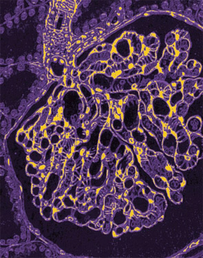 Lupus Nephritis Guidelines in Progress