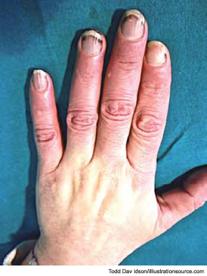 Figure 1: A 58-year-old female came to our rheumatology clinic in the winter suffering from cold hands (intensive Raynaud’s phenomenon). Symptoms began in 2004 and medical history is negative.