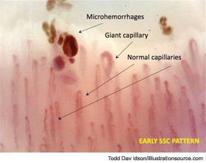 Figure 2: The nailfold videocapillaroscopic analysis shows the combination of giant capillaries and microhemorrhages (early scleroderma pattern) that identify the systemic sclerosis microvessel damage associated with secondary Raynaud’s, which is often long lasting (magnification x200).