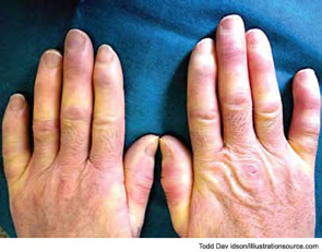 Figure 3: The most common initial symptom and clinical sign of systemic sclerosis is symmetrical Raynaud’s phenomenon.