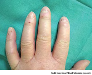 Figure 4: The insidious swelling of the distal extremities (e.g., puffy fingers), followed by gradual thickening of the skin of the fingers, characterize the progression of systemic sclerosis versus the fibrotic phase.