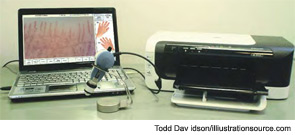 Figure 5: At the level of the nailfolds, it is possible to detect the progression of the morphological changes using the videocapillaroscope, a safe and noninvasive tool that is practically an immersion microscope connected to a microcamera.