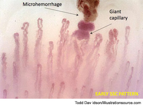 Figure 6: The nailfold capillaroscopic early scleroderma pattern is characterized by the presence of giant capillaries (homogeneous and symmetrical capillary enlargement over 50 micrometers) and microhemorrages (magnification x200) (early pattern).