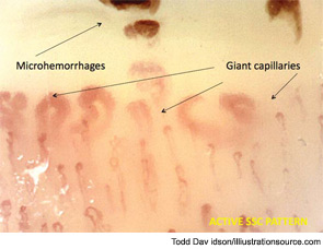 Figure 8: The dynamic involvement of capillaries by the immunopathological process in SSc can worsen the capillaroscopic pattern (from early to active pattern) and become linked to overt clinical symptoms of the disease (i.e., skin trophic lesions) (magnification x200) (active pattern).