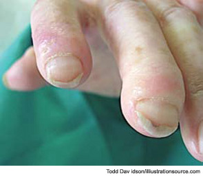 Figure 9: Typical skin trophic lesions are visible in the finger of an SSC patient with an active capillaroscopic pattern.