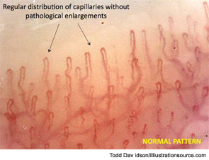 Figure 10: As the pathophysiological process of SSc progresses into fibrosis, the capillaroscopic pattern most likely reflects the effects of tissue hypoxia; massive capillary destruction, loss of capillaries, and avascular areas are observed along with ramifications and bushy capillaries, indicating neoangiogenesis (magnification x200) (late pattern).