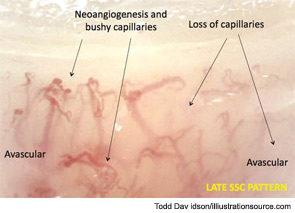 Figure 12: The normal nailfold capillaroscopic pattern, which occurs in healthy subjects or in patients with benign primary Raynaud’s phenomenon, is clearly different from the scleroderma capillaroscopic patterns.