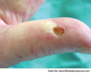 Figure 13: Loss of capillaries may lead to tissue hypoxia; the most common clinical complication in SSc is the development of digital ulcers.