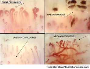 Figure 14: The most important capillaroscopic aspects of microvascular damage that are considered as markers for the definition of the scleroderma pattern.