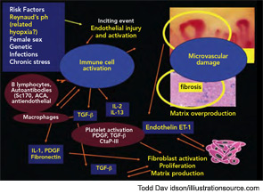 Figure 15: Recent studies indicate that treatment of SSc can reduce the microvasculature damage. Regression of the early capillaroscopic markers (e.g., giant capillaries and microhemorrhages) and reversal of the qualitative patterns can be obtained with immunosuppressive therapies (left blue oval). Vasoactive drugs (e.g., prostanoids and/or endothelin-receptor blockers) can also modulate the vascular/fibrosis-related symptoms and tissue consequences (right blue oval).