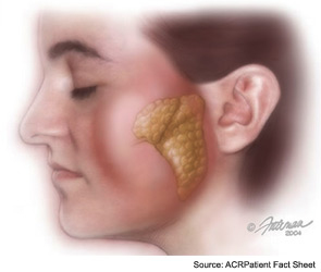 Sjögren's syndrome