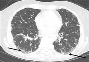 HRCT image with peripheral, basilar predominant honeycombing and traction bronchiectasis suggestive of UIP pattern