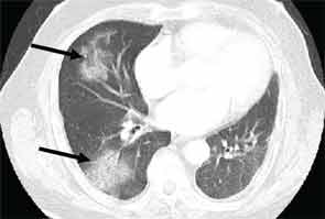 HRCT image with dense areas of consolidation (arrows), suggesting a pattern of organizing pneumonia.