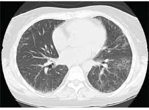 HRCT image demonstrating ground glass opacifications suggestive of NSIP pattern.