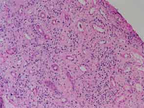 Tubulointerstitial nephritis