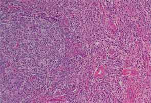 Collagen stain (blue) demonstrating fibrosis within the renal interstitium