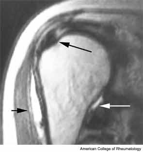 How to Evaluate Shoulder Pain