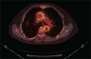 PET CT scan of a patient with biopsy-proven GCA, showing increased FDG uptake in the walls of the ascending and descending aorta.