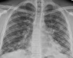 Chest radiograph showing nodular opacities in both lungs.