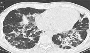 CT scan of the lung showing multifocal areas of ground-glass and reticular opacities.