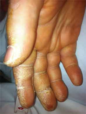 Thickened and cracked skin, most pronounced on the palmar aspect of the thumb, index, and middle fingers, consistent with mechanic’s hands