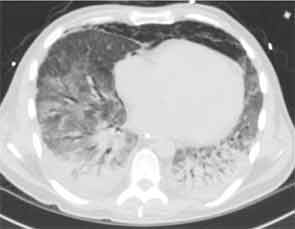 Diffuse ground-glass opacities, posterior lobe predominant consolidations, and pneumomediastinum.