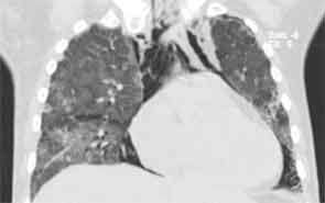 Diffuse ground-glass opacities, posterior lobe predominant consolidations, and pneumomediastinum.