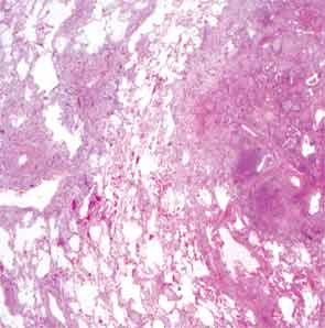 Diffuse alveolar damage. Transition between less-involved lung and severely involved lung