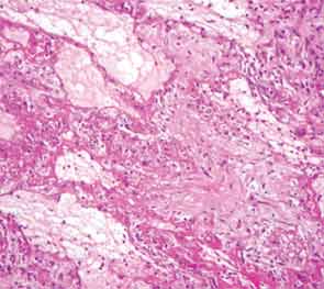 Hyaline membranes define the pathologic finding of diffuse alveolar damage. Both acute (bright pink, thin membranes) and organizing (more cellular regions) phases are seen