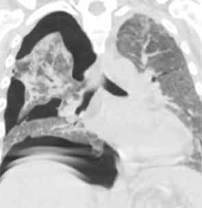 ARDS and pneumothorax