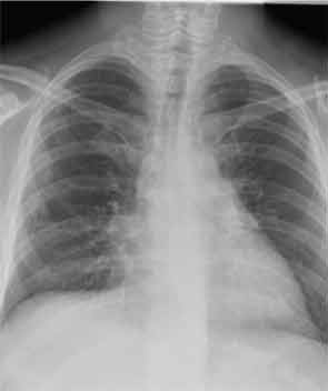 Chest X-ray March 2013: Clear lungs. Mild right-lung volume loss. No pneumothorax.