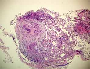 Transbronchial biopsy of the right upper lung, anterior segment