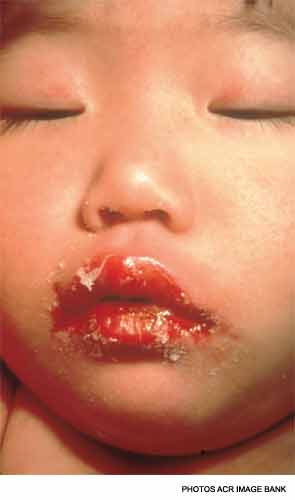 Note the fissured, erythematous and desquamated lips in this 2-year-old girl with Kawasaki disease.