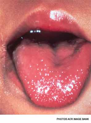 This swollen, granular appearance of the tongue is characteristic of Kawasaki disease.