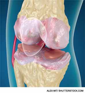 Addressing Inflammatory Bone Disease