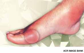 ACR's Gout Guidelines