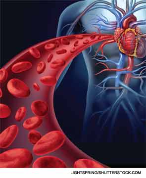 Patients taking 0.5 mg/d of colchicine or placebo for at least two years had about a 65% lower risk of any acute coronary syndrome, heart attack or stroke. 