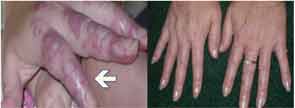 Figure 4: Left: Extensive avascular lesions with telangectatic borders on a second patient’s digits and hands before treatment with treprostinil. Right: Her hands after treatment with treprostinil.