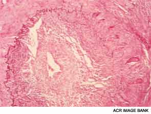 In half the field, the internal elastic lamina and media of a temporal artery are intact. In the other half, both have been destroyed and replaced by a granulomatous reaction and exudate that contains giant cells and epithelioid cells. The exudate extends into the intima, where there is extensive necrosis. 