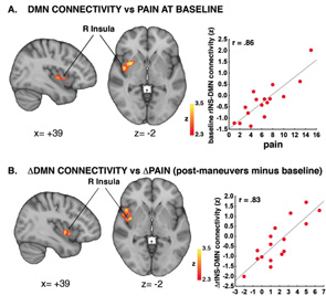 DMN-insula connectivity correlates with clinical pain. A) The more spontaneous the pain, the more the insula (colored blob) becomes connected to the DMN. B) The more the pain is experimentally exacerbated (e.g., using straight leg raises), the more the insula-DMN connectivity increases.3